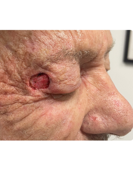 Skin Cancer Reconstruction case #17989
