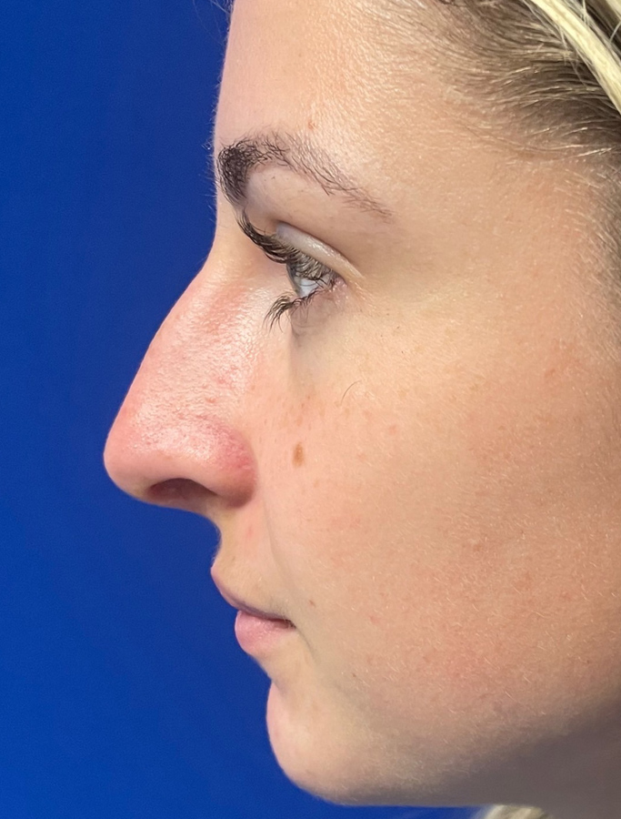 Rhinoplasty case #1669