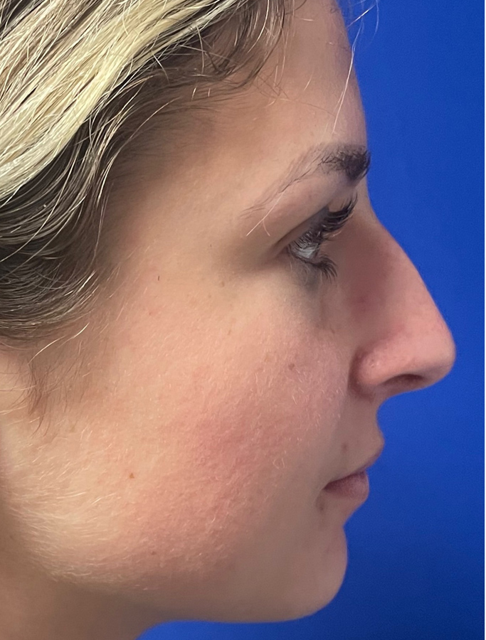 Rhinoplasty case #1669