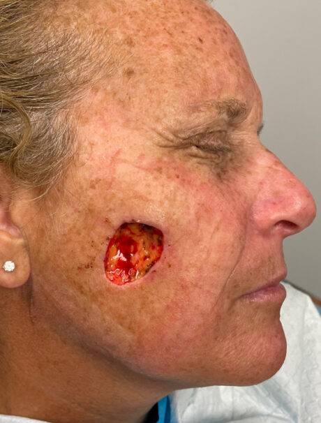 Skin Cancer Reconstruction case #1719