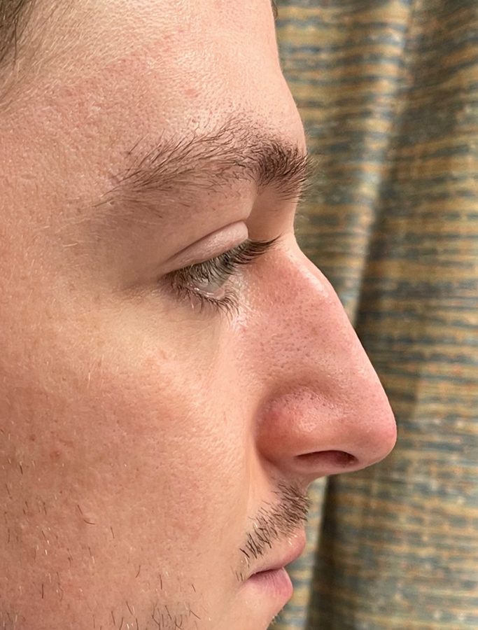 Rhinoplasty case #2033