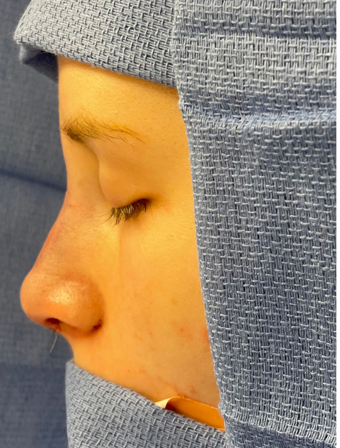 Rhinoplasty case #1988