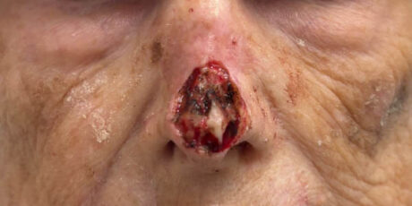 Skin Cancer Reconstruction case #17980