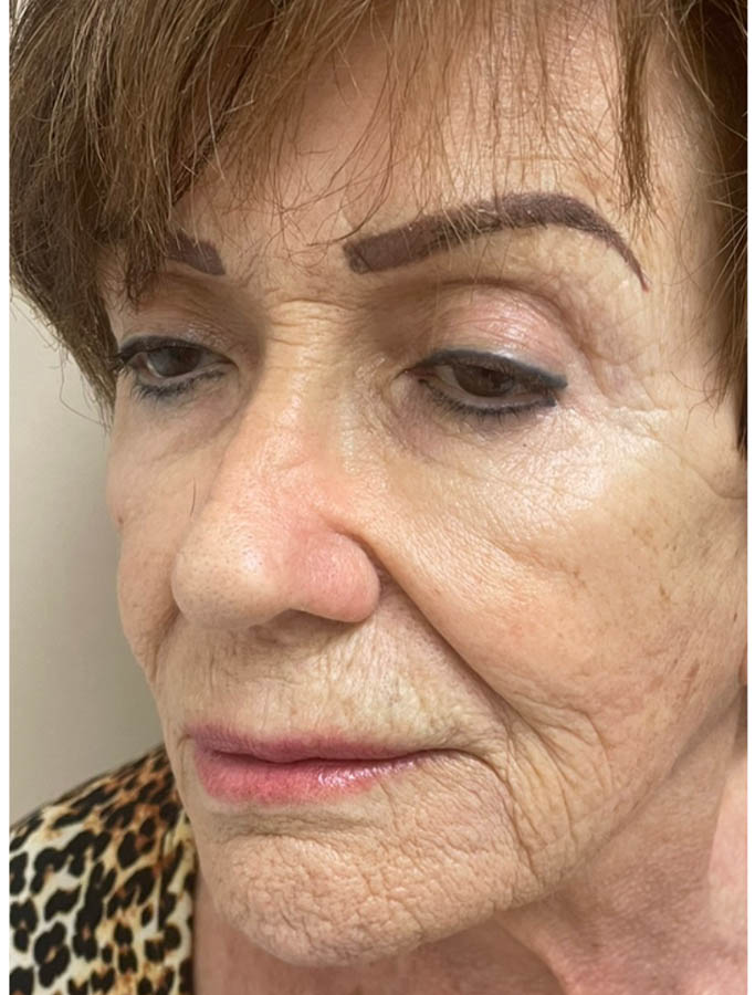 Skin Resurfacing case #18121