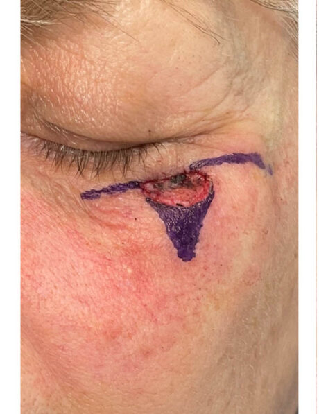 Skin Cancer Reconstruction case #18051
