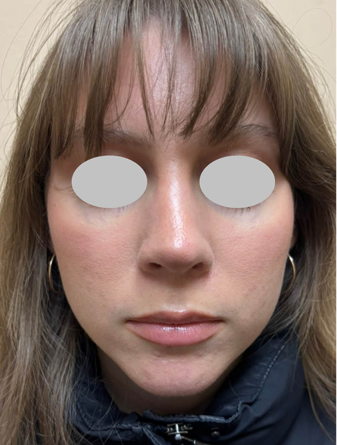 Rhinoplasty case #18129