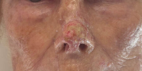 Skin Cancer Reconstruction case #17980