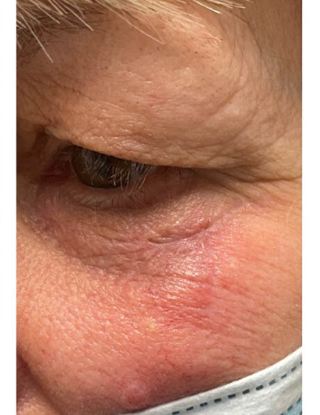 Skin Cancer Reconstruction case #18051