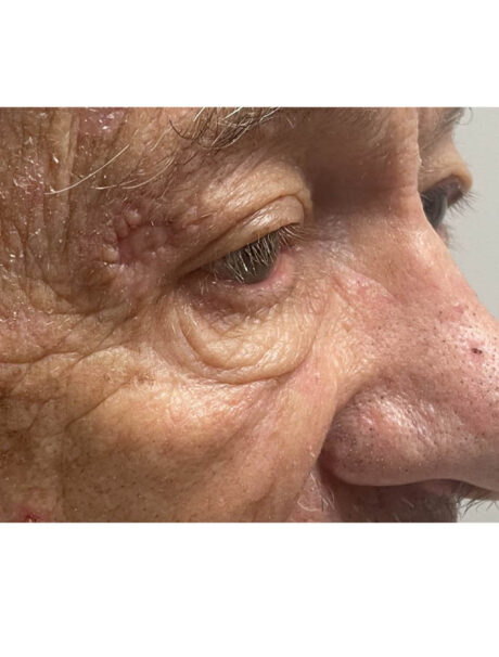Skin Cancer Reconstruction case #17989