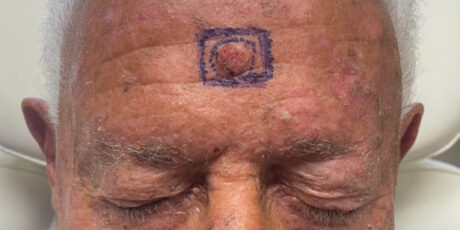 Skin Cancer Reconstruction case #17983