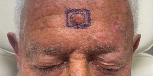 Skin Cancer Reconstruction case #17983