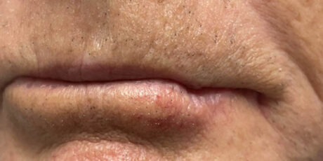 Skin Cancer Reconstruction case #17977