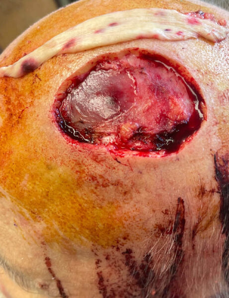 Skin Cancer Reconstruction case #18071