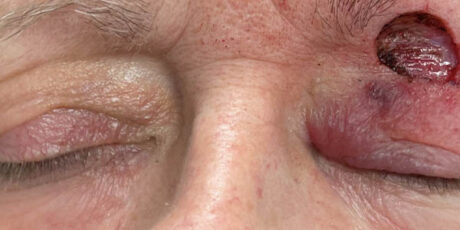 Skin Cancer Reconstruction case #17972