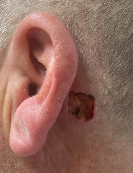 Skin Cancer Reconstruction case #18066