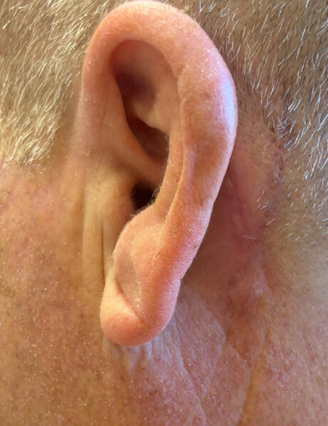 Skin Cancer Reconstruction case #18066