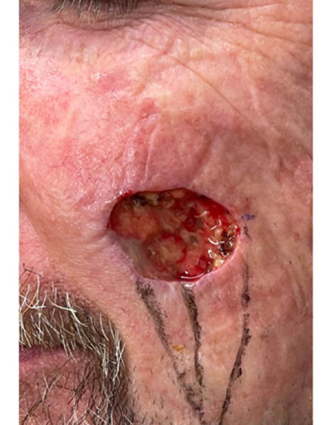Skin Cancer Reconstruction case #18054