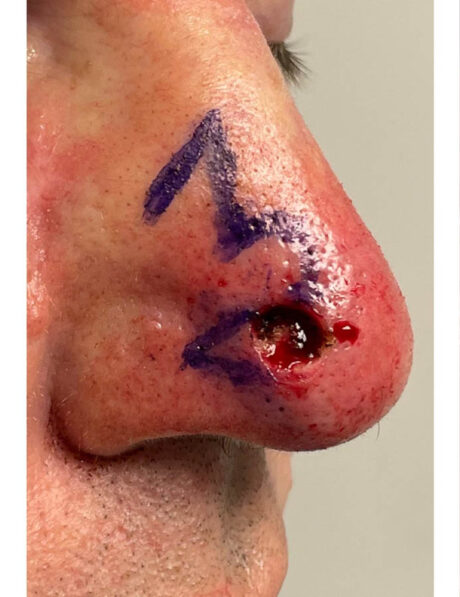 Skin Cancer Reconstruction case #18057