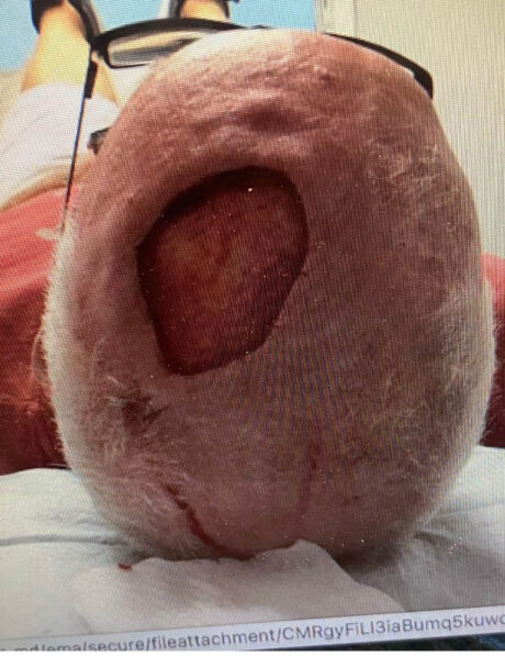 Skin Cancer Reconstruction case #18060