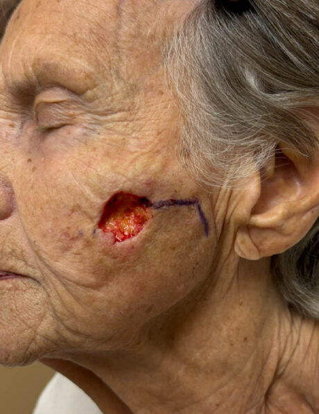 Skin Cancer Reconstruction case #18063
