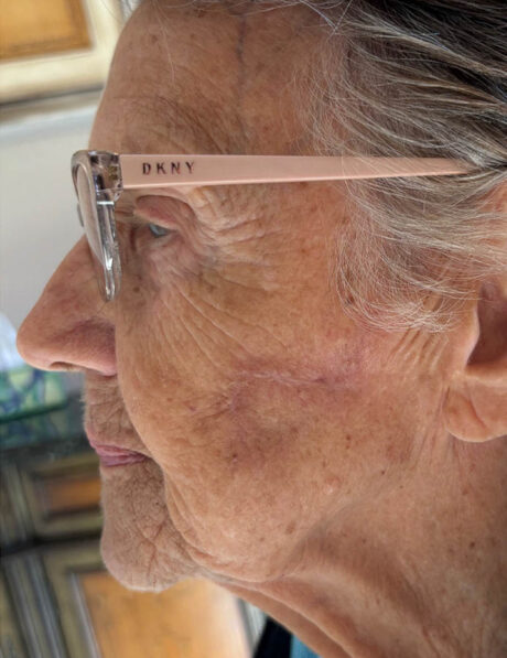 Skin Cancer Reconstruction case #18063