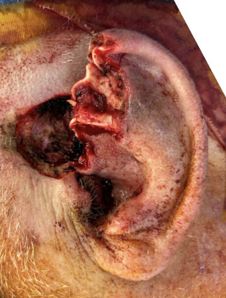 Skin Cancer Reconstruction case #18035
