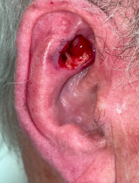 Skin Cancer Reconstruction case #18032