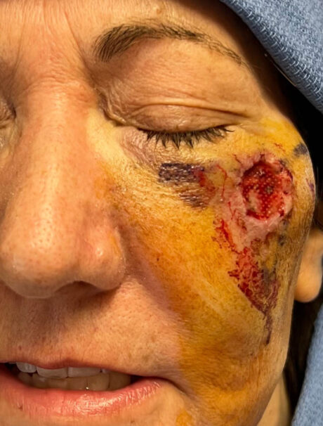 Skin Cancer Reconstruction case #18027