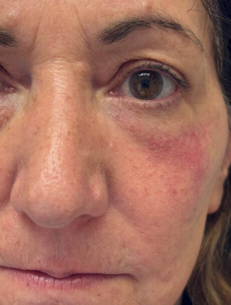 Skin Cancer Reconstruction case #18027