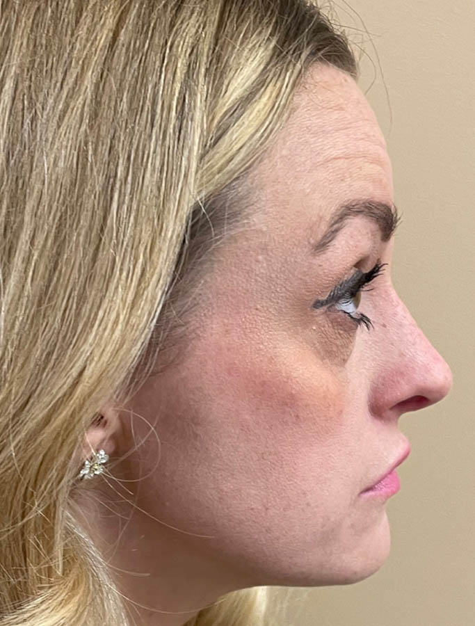 Rhinoplasty case #18153