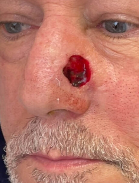 Skin Cancer Reconstruction case #18022