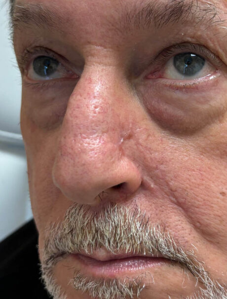 Skin Cancer Reconstruction case #18022
