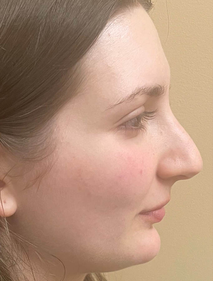 Rhinoplasty case #18165