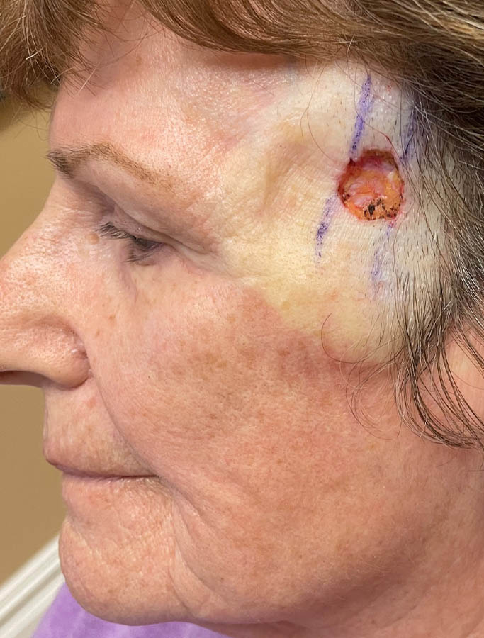 Skin Cancer Reconstruction case #18019