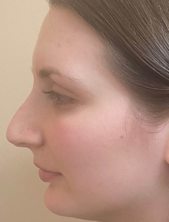 Rhinoplasty case #18165