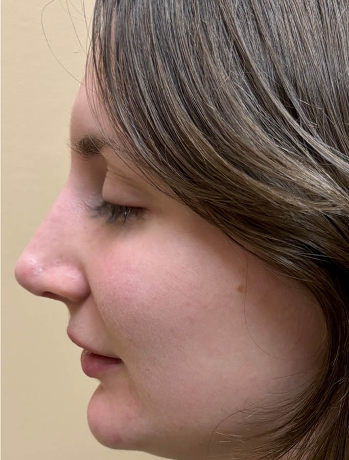 Rhinoplasty case #18165