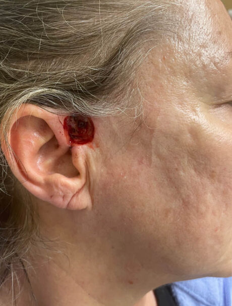 Skin Cancer Reconstruction case #18011