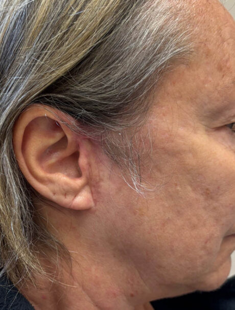 Skin Cancer Reconstruction case #18011