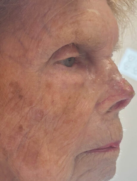 Skin Cancer Reconstruction case #18008
