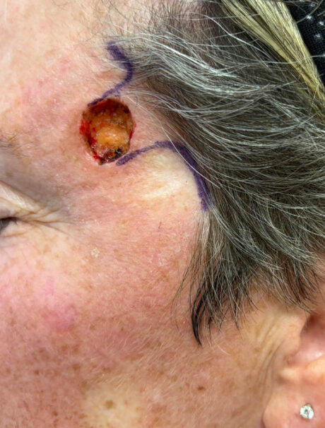 Skin Cancer Reconstruction case #18005