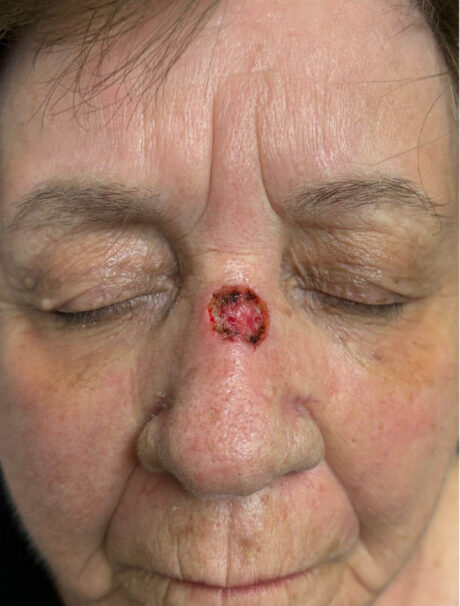 Skin Cancer Reconstruction case #18002