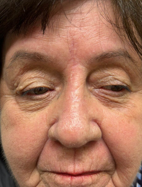 Skin Cancer Reconstruction case #18002