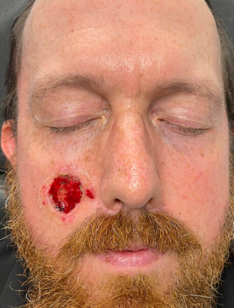 Skin Cancer Reconstruction case #17995