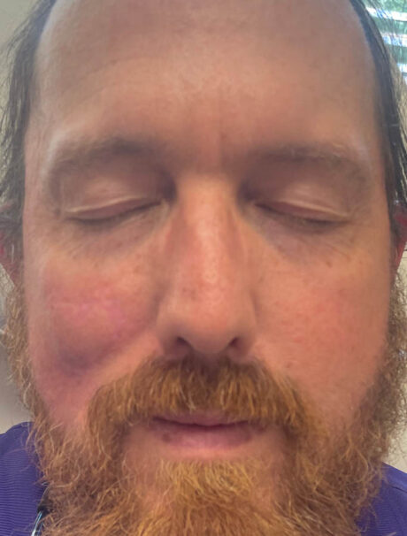 Skin Cancer Reconstruction case #17995