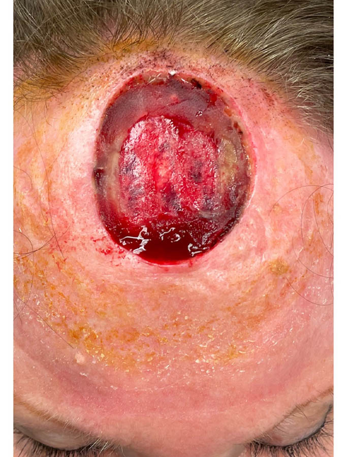 Skin Cancer Reconstruction case #17992