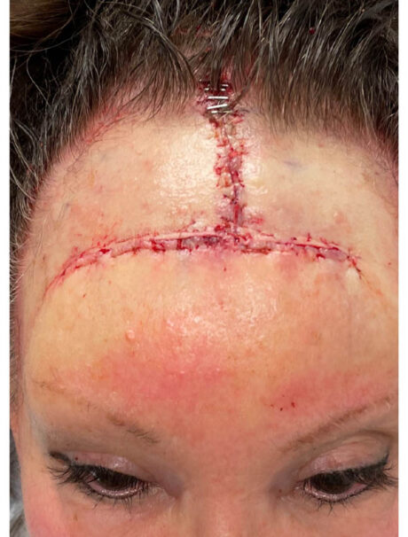 Skin Cancer Reconstruction case #17992