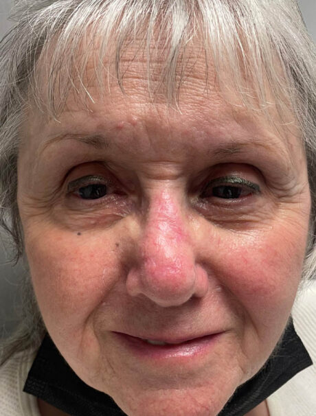 Skin Cancer Reconstruction case #18038