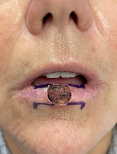 Skin Cancer Reconstruction case #18080