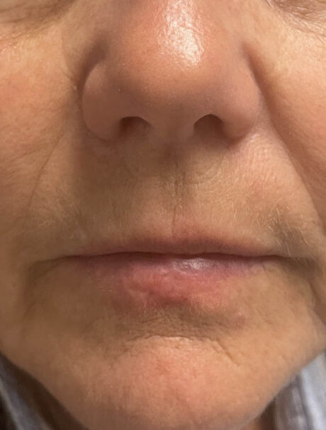 Skin Cancer Reconstruction case #18080