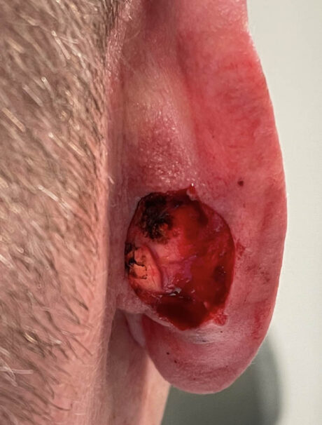 Skin Cancer Reconstruction case #18074